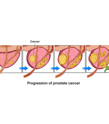 Prostate Cancer