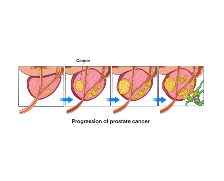 Prostate Cancer